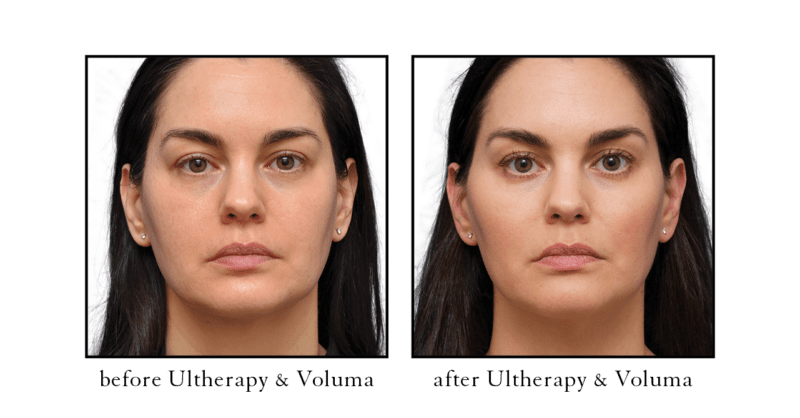 Ultherapy Skin Tightening Cosmetic Skin Laser Center