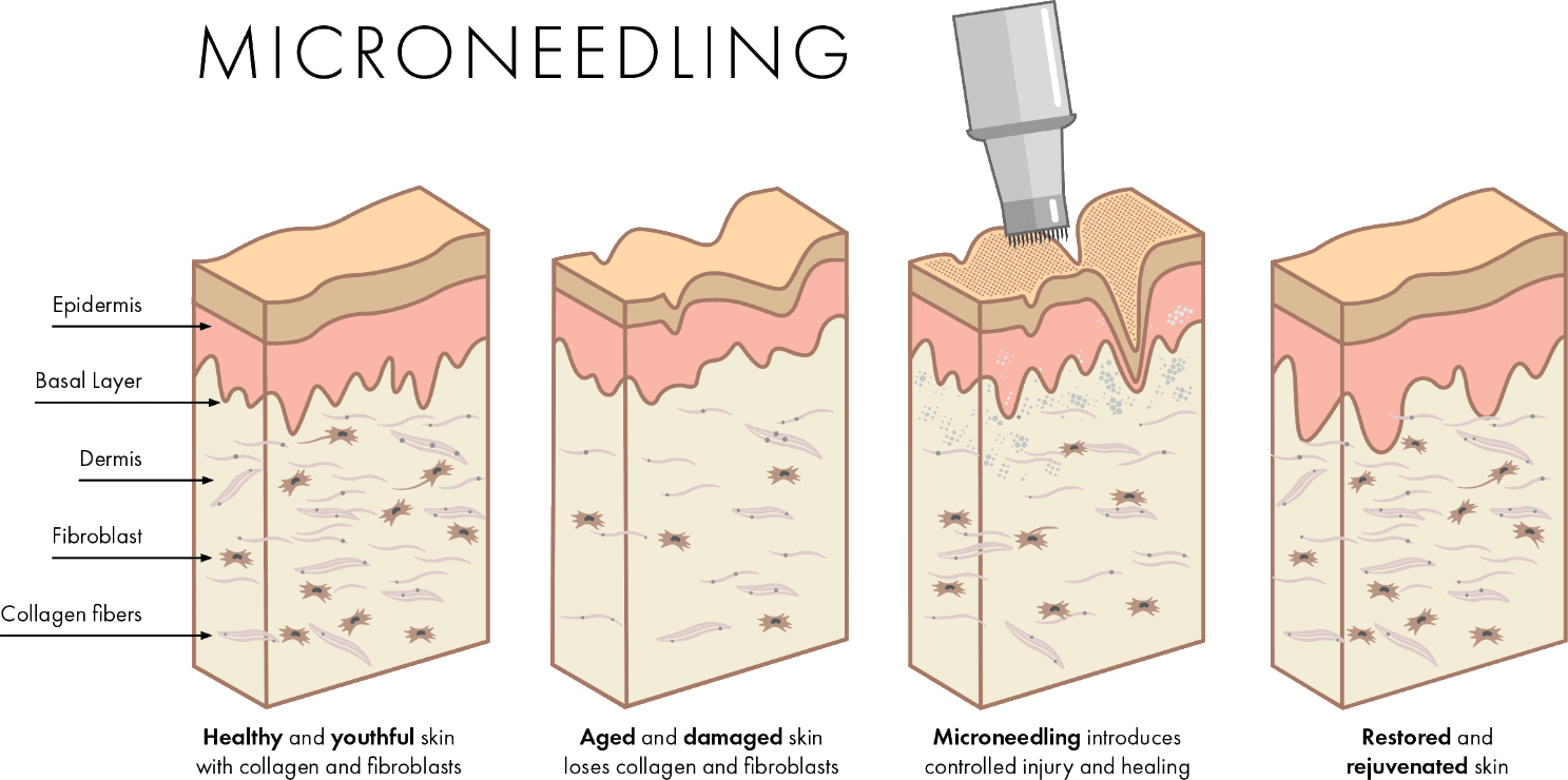 The microneedline process illustration