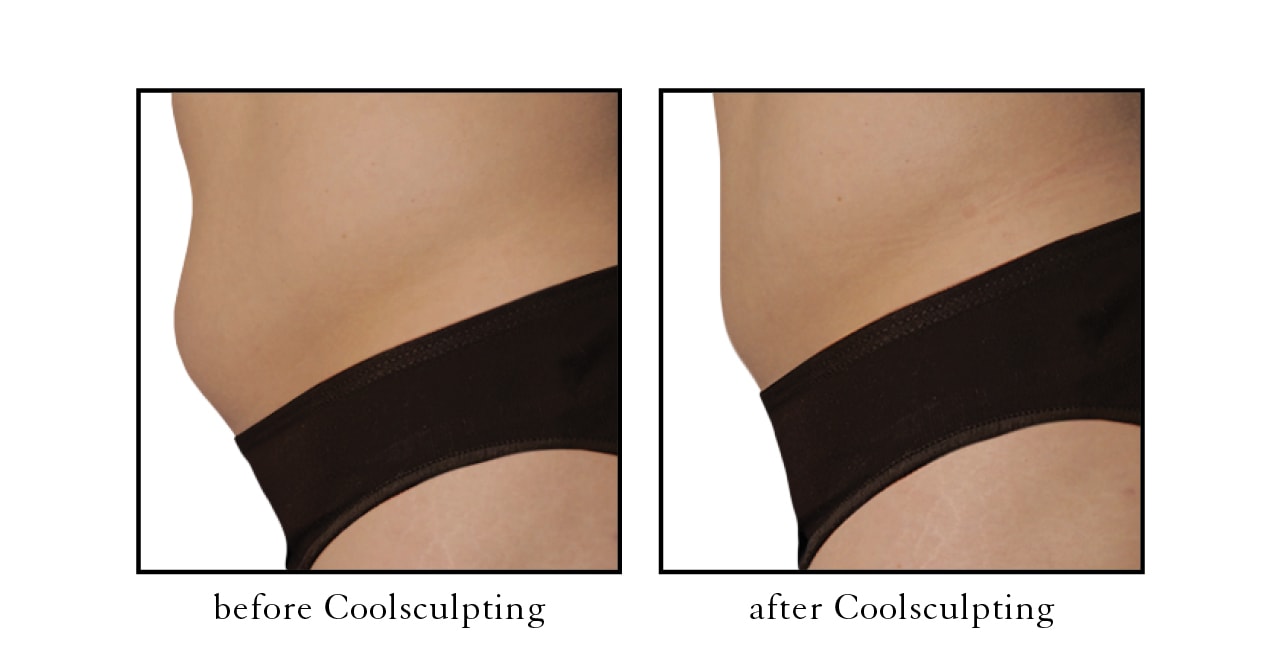 Coolsculpting abdomen