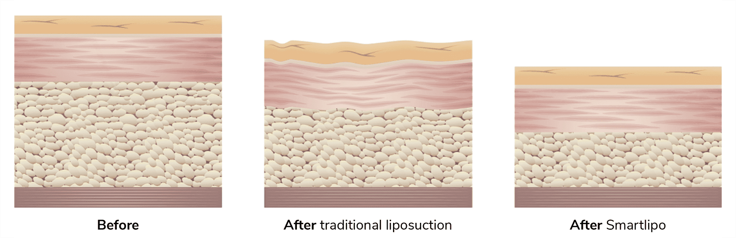 smartlipo vs traditional lipo