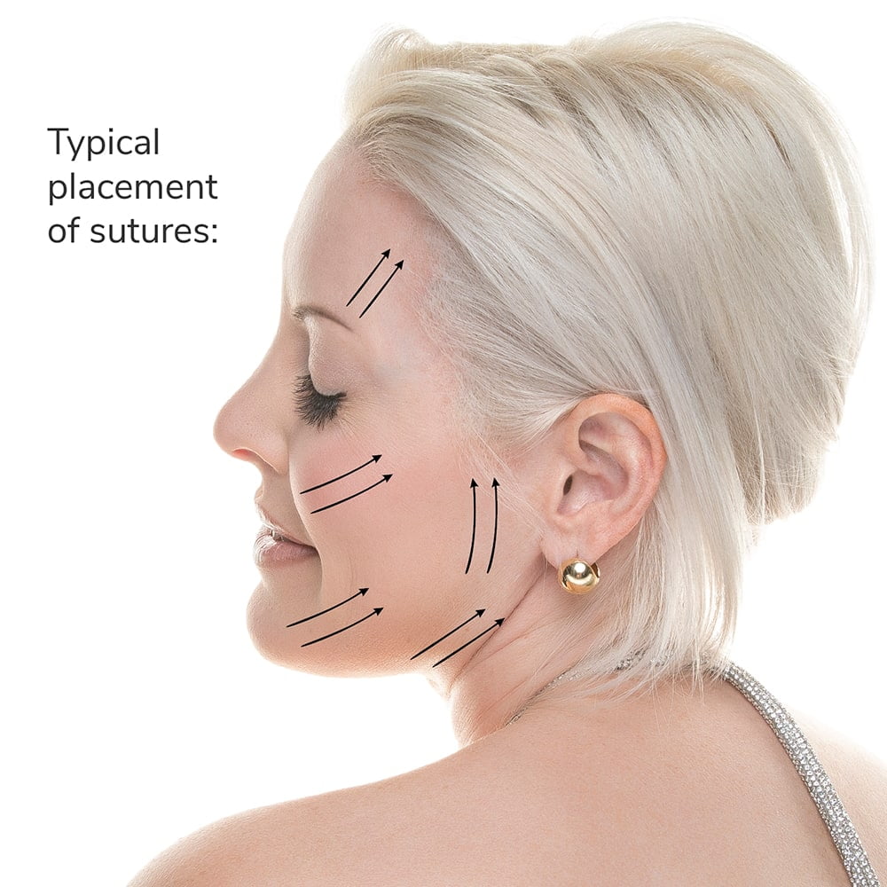 Face Thread Lift For V-Shape Face And Tighter Skin: How Does It Work?