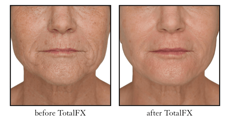 totalfx laser before after totalfx laser before after