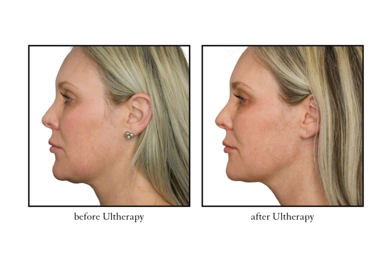 Ultherapy at Cosmetic Skin & Laser Center