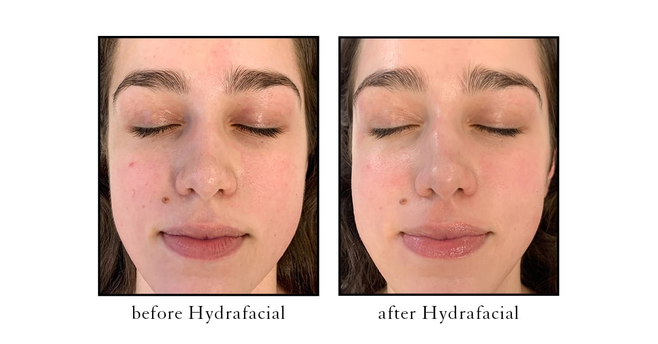 before after hydrafacial