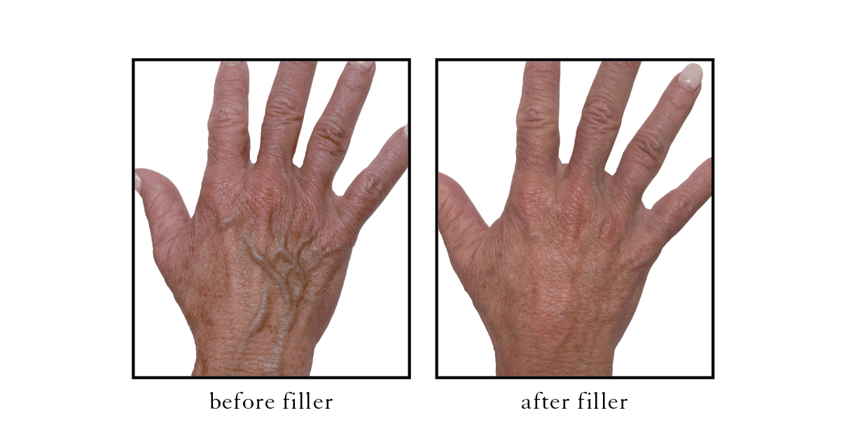 Hand rejuvenation Cosmetic Skin & Laser Center