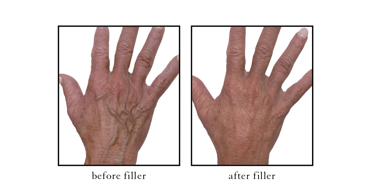 hand rejuvenation Hand rejuvenation Cosmetic Skin & Laser Center