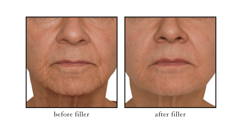 Cheek filler before and after photo showing natural lift and facial contouring at Cosmetic Skin and Laser Center