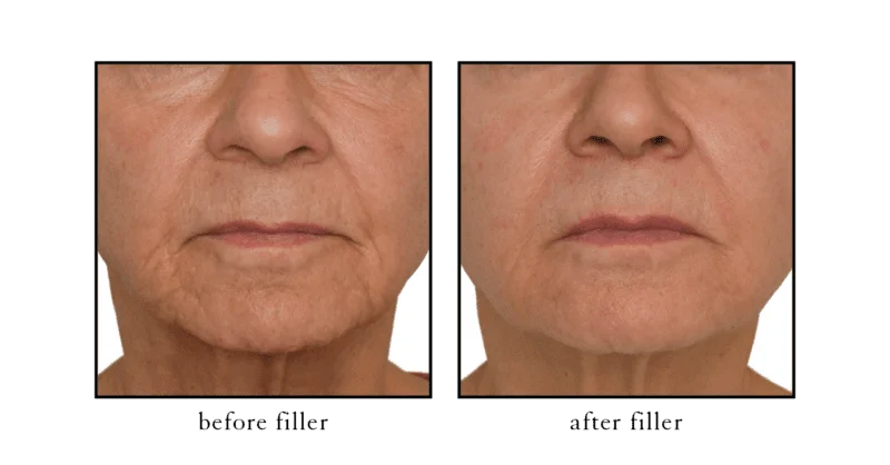 Cheek filler before and after photo showing natural lift and facial contouring at Cosmetic Skin and Laser Center