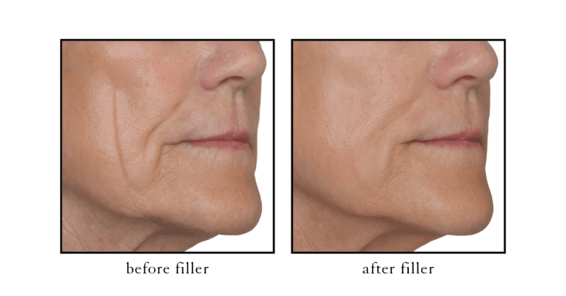 Cheek filler before and after results showing midface volume restoration at CSLC