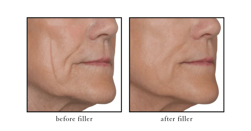 Cheek filler before and after results showing midface volume restoration at CSLC