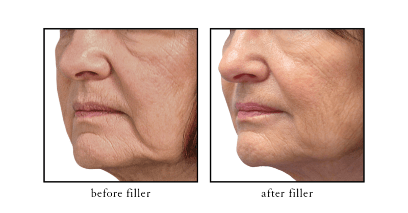 Jawline filler before and after results showing improved definition and facial balance at CSLC
