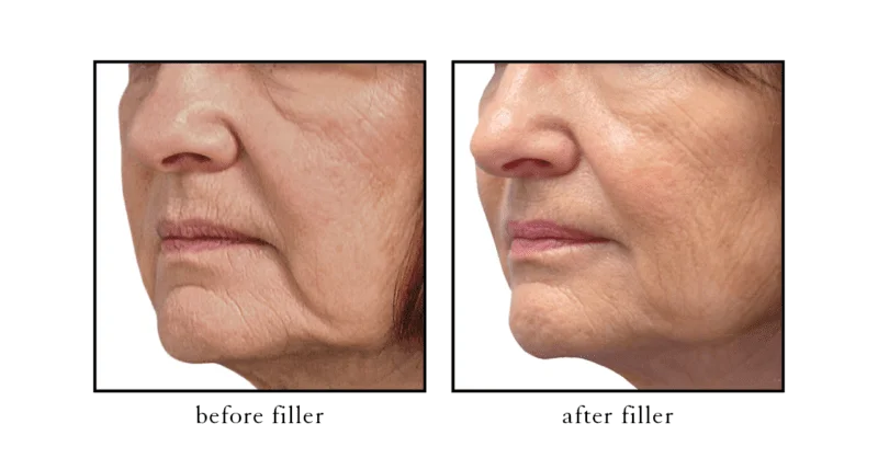 Jawline filler before and after results showing improved definition and facial balance at CSLC