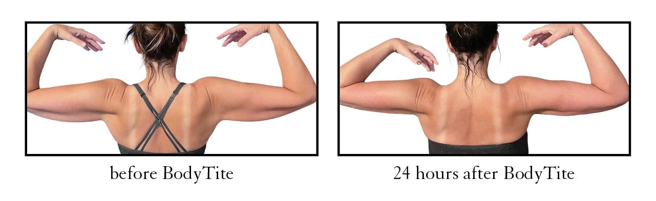 Unlocking the Potential of Arm Liposuction: Exercises, Procedures