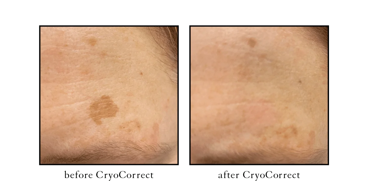 cryocorrect cryocorrect Cosmetic Skin & Laser Center