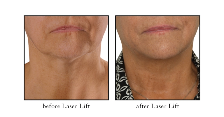 Laser Lift before after