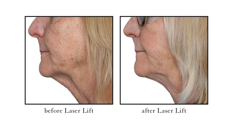 Laser Lift before after