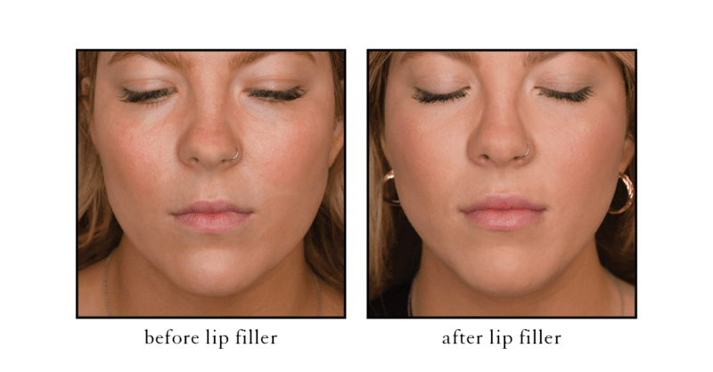 Lip filler before and after results showing natural fullness and definition at CSLC