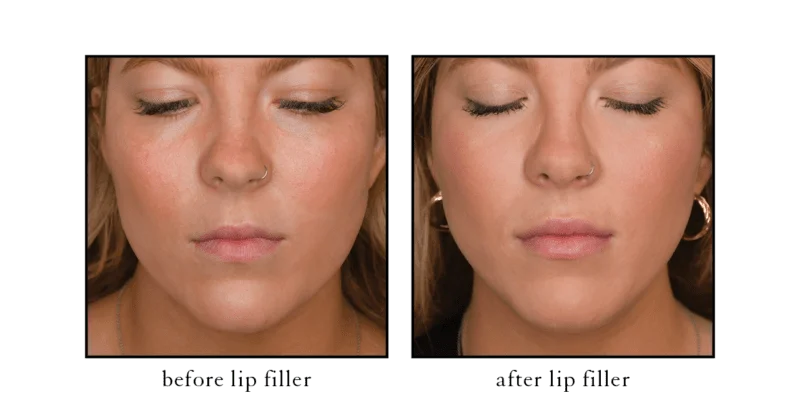 Lip filler before and after results showing natural fullness and definition at CSLC