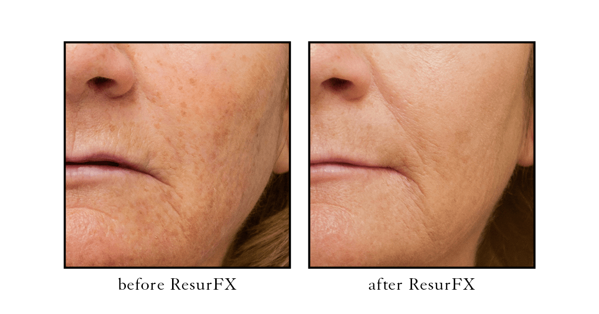 resurfx Cosmetic Skin & Laser Center