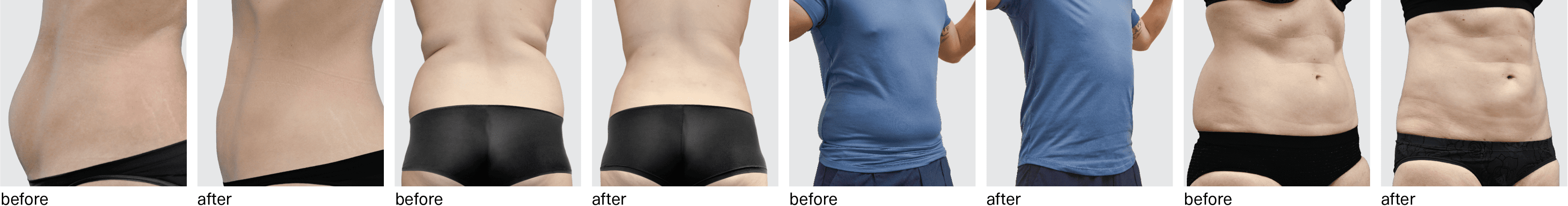 Smartlipo Skin Tightening for Mom (Tummy Tuck Alternative) Before & After  Photos New Jersey - Reflections Center