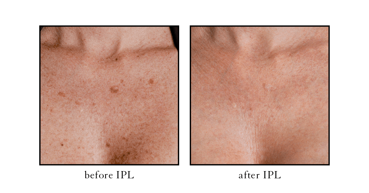 IPL before after