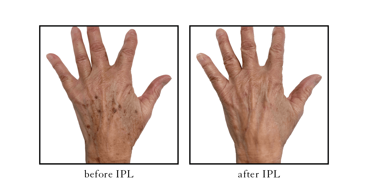 IPL before after