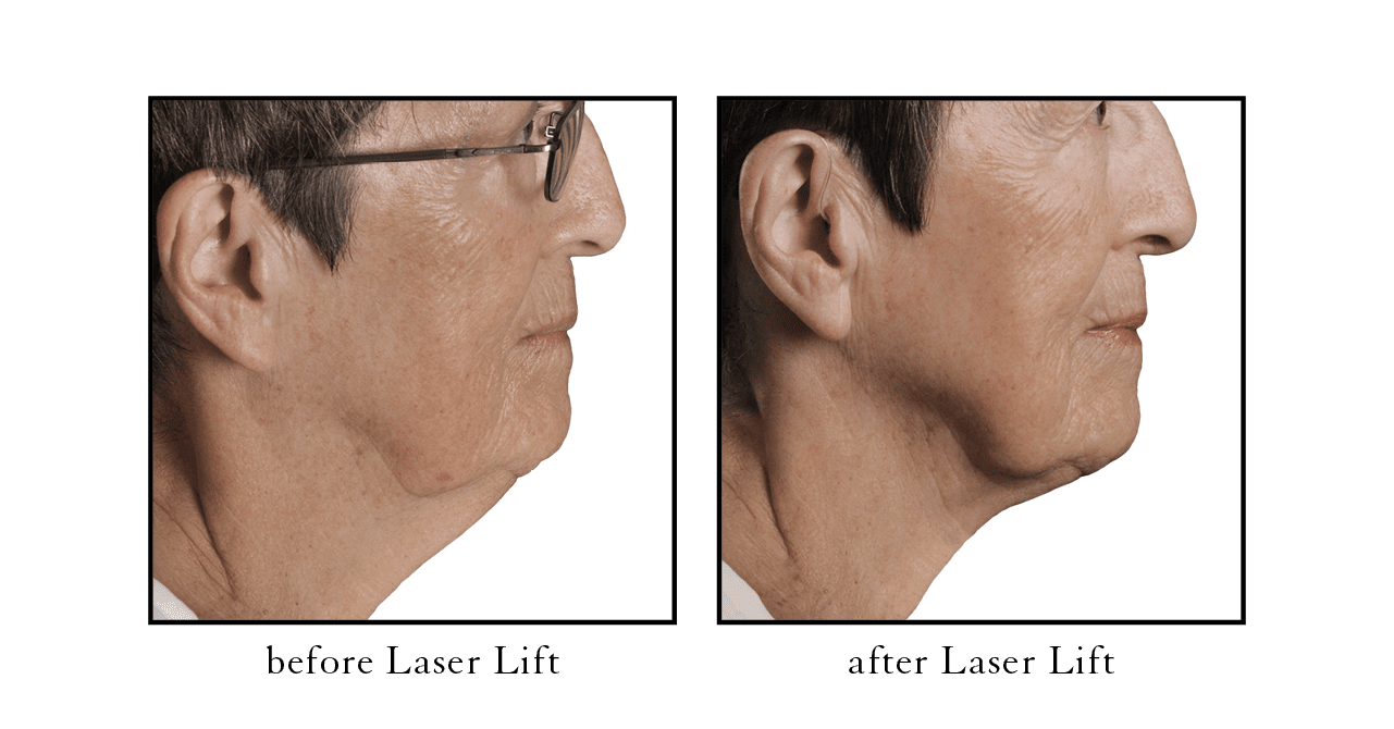 Laser Lift Facelift Alternative