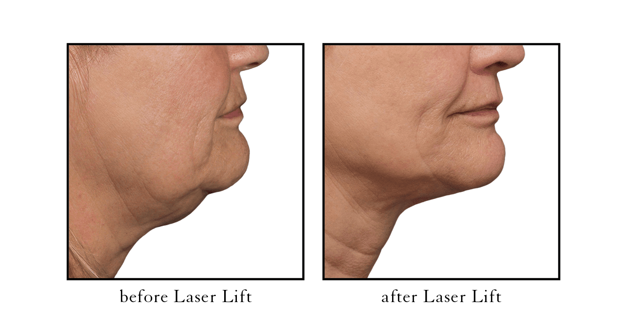 Laser Lift Facelift Alternative Cosmetic Skin Laser Center