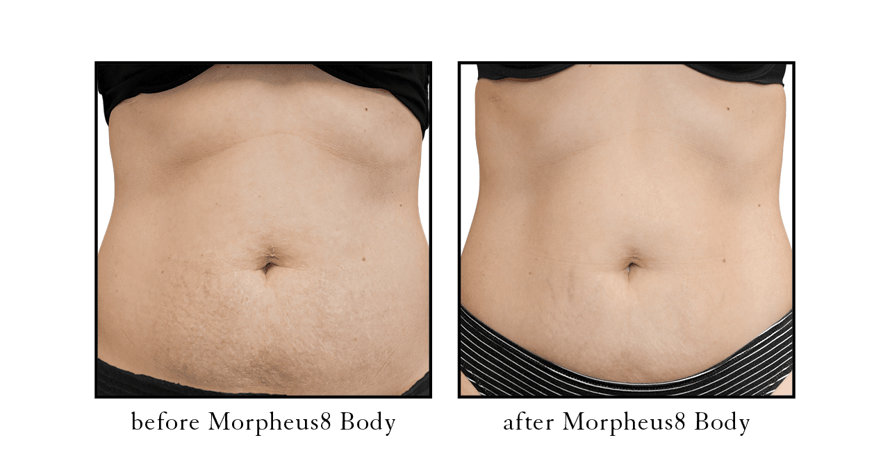 Morpheus8 Body – Tighten & Smooth