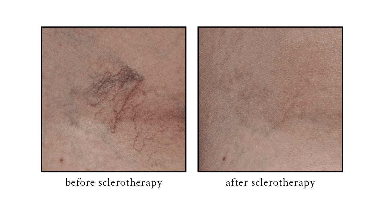 sclerotherapy