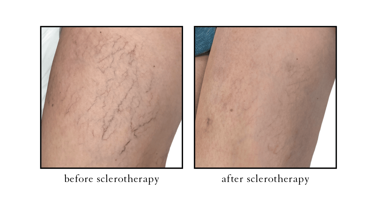 sclerotherapy