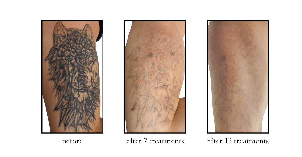 Laser tattoo removal  Enlighten tattoo removal  Harleh Laser Clinic  Pukekohe