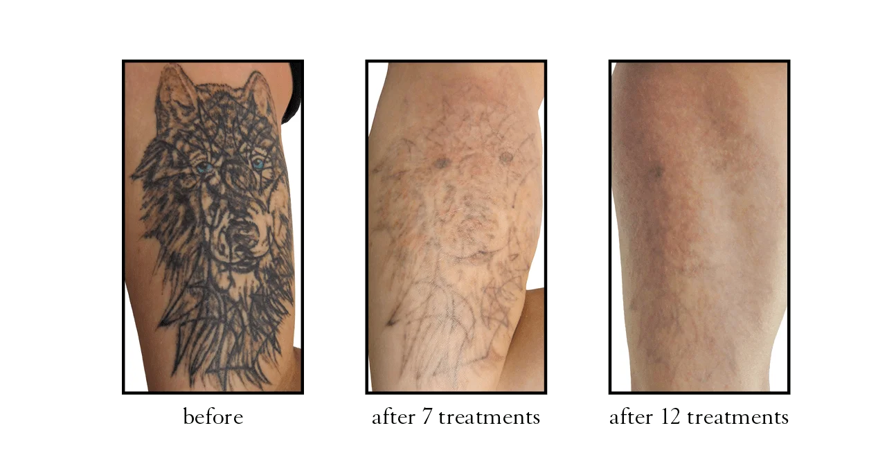 tattoo removal tattoo removal