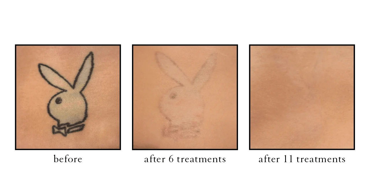 tattoo removal2 tattoo removal