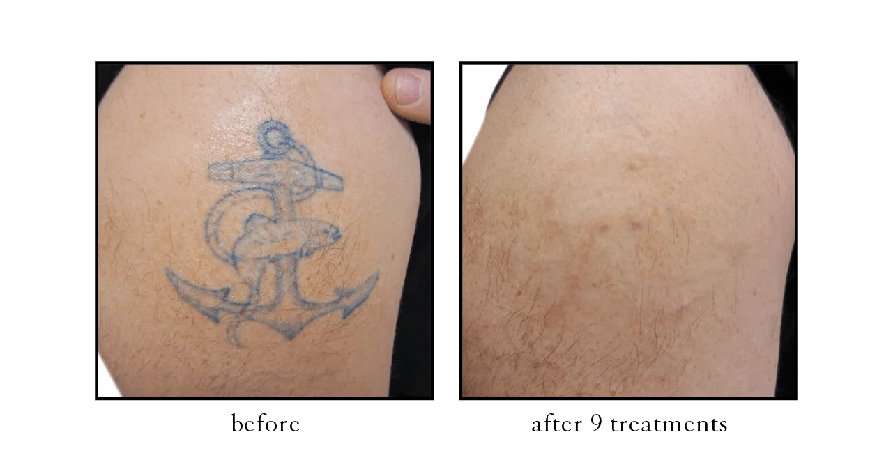 tattoo removal3 tattoo removal