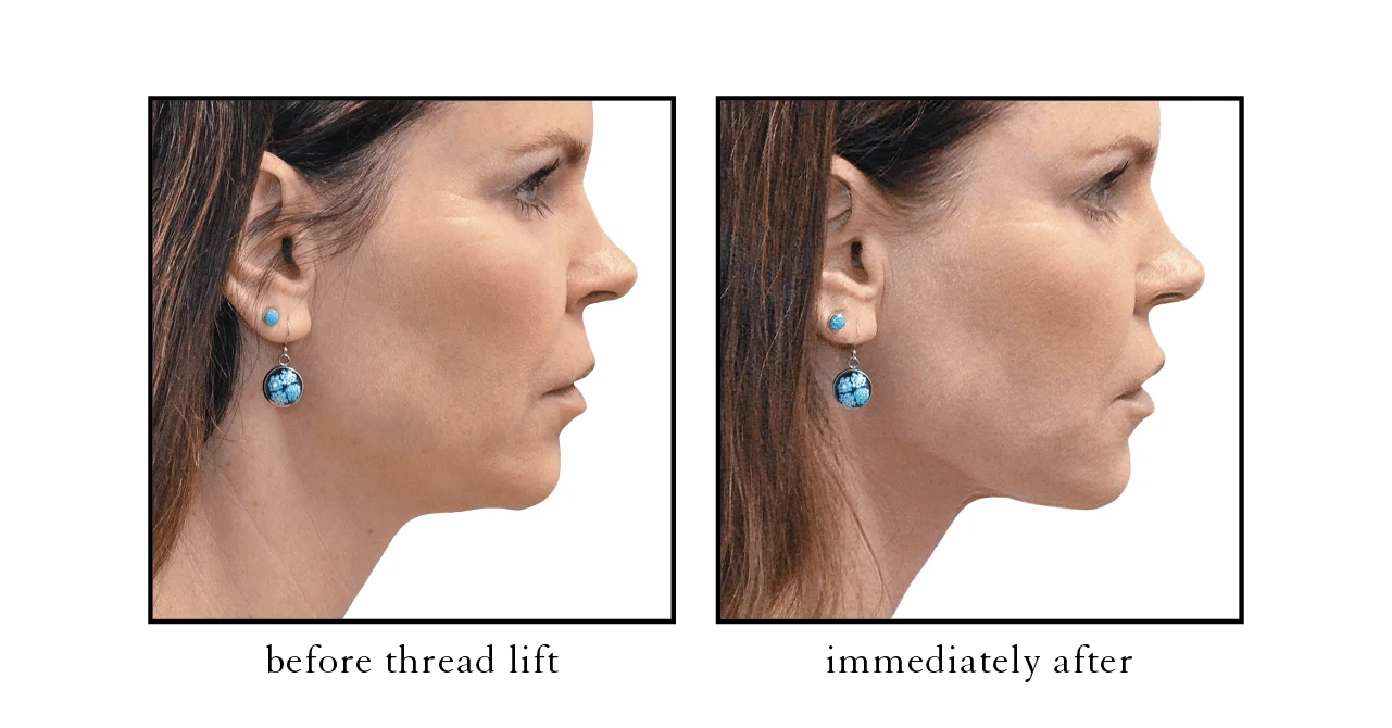 thread lift1 thread lift