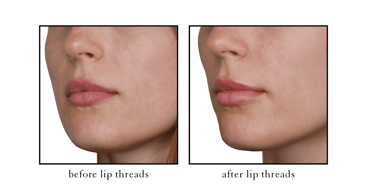 thread lift4 thread lift