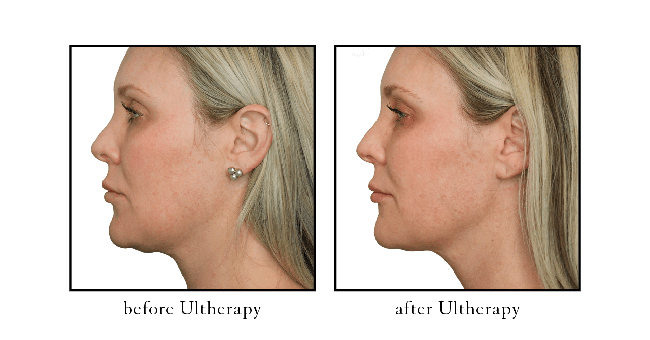 Treating Chest Wrinkles At Any Age With Ultherapy - Radiance Skincare &  Laser Medspa