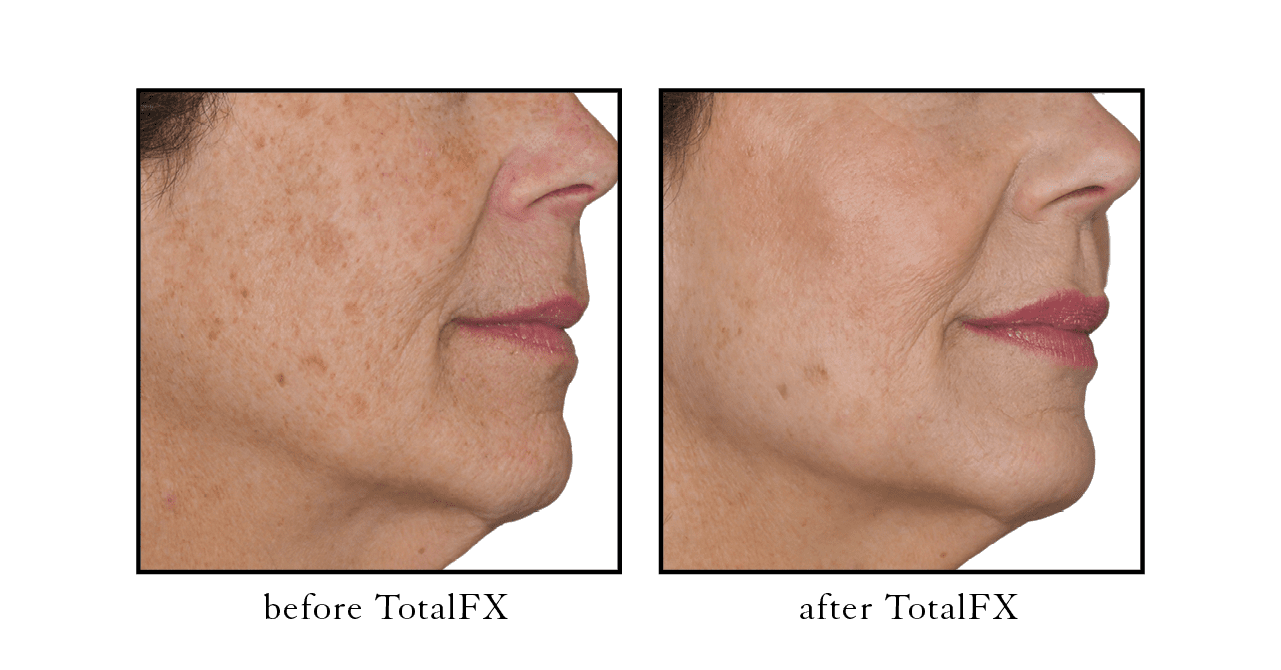 Pulse Light Clinic - Our clients recovery journey with CO2 laser for acne  scar removal ​- ​What is the CO2 Laser? - The CO2 laser is a fractional  treatment for skin rejuvenation