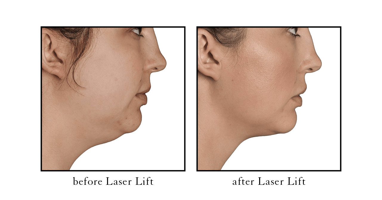 laser lift before after