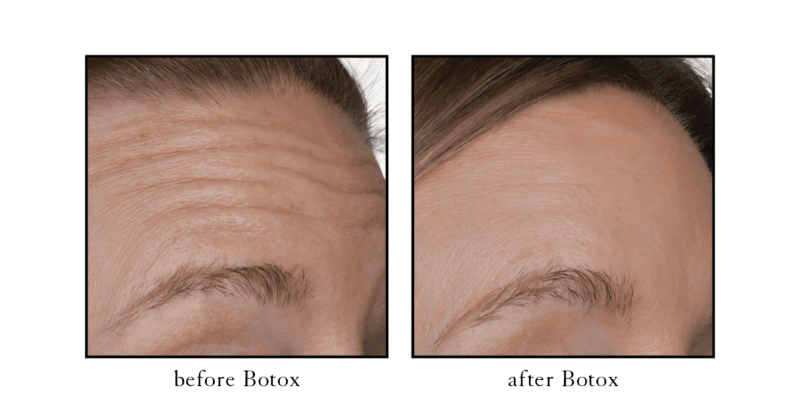 Botox before and after results for forehead wrinkles and horizontal lines at CSLC
