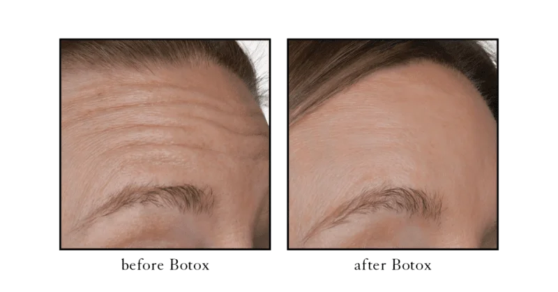 Botox before and after results for forehead wrinkles and horizontal lines at CSLC