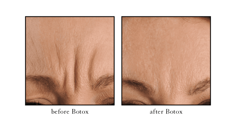 Botox before and after showing smoothed frown lines between the brows (glabellar lines) at CSLC