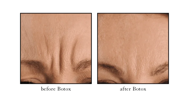 Botox before and after showing smoothed frown lines between the brows (glabellar lines) at CSLC