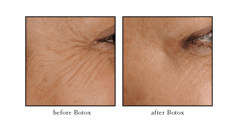 Botox before and after showing reduced crow's feet around the eyes at CSLC