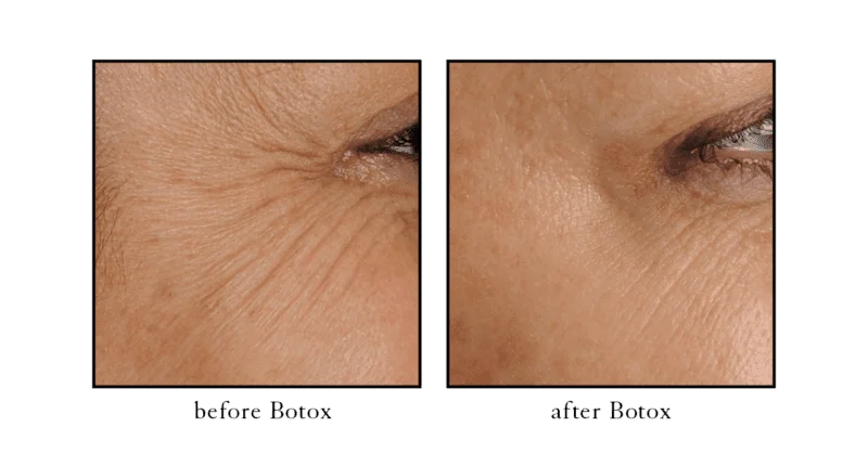 Botox before and after showing reduced crow's feet around the eyes at CSLC