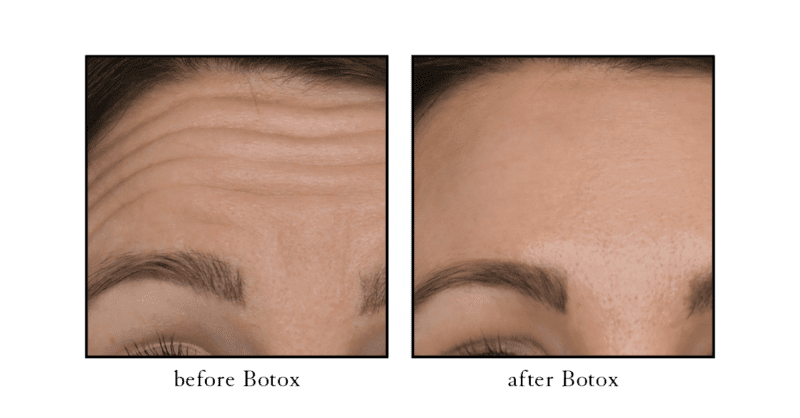 Botox before and after photo showing forehead line improvement at Cosmetic Skin and Laser Center
