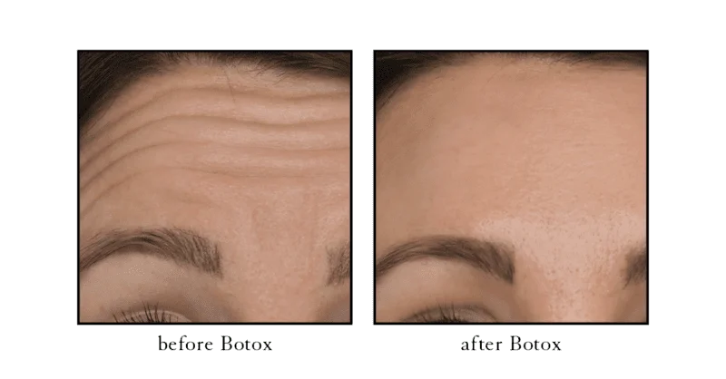 Botox before and after photo showing forehead line improvement at Cosmetic Skin and Laser Center