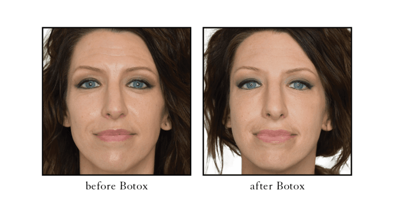 Botox before and after results showing smoother forehead lines and reduced nasolabial folds at CSLC