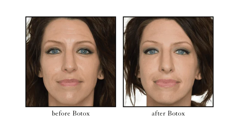 Botox before and after results showing smoother forehead lines and reduced nasolabial folds at CSLC